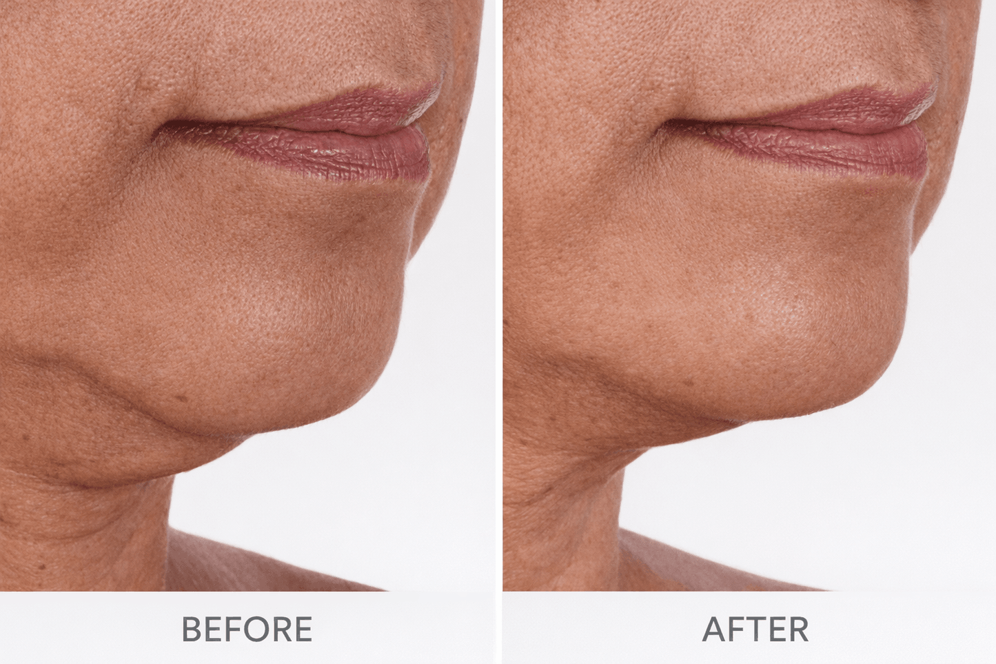 Before and after Velino LUMERA Lift Pro  visibly toned chin and reduced sagging around the jawline after 4 weeks of use