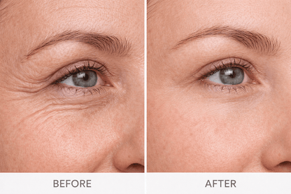 Before and after Velino LUMERA Lift Pro  reduced crow's feet and lifted under-eye area after consistent daily use