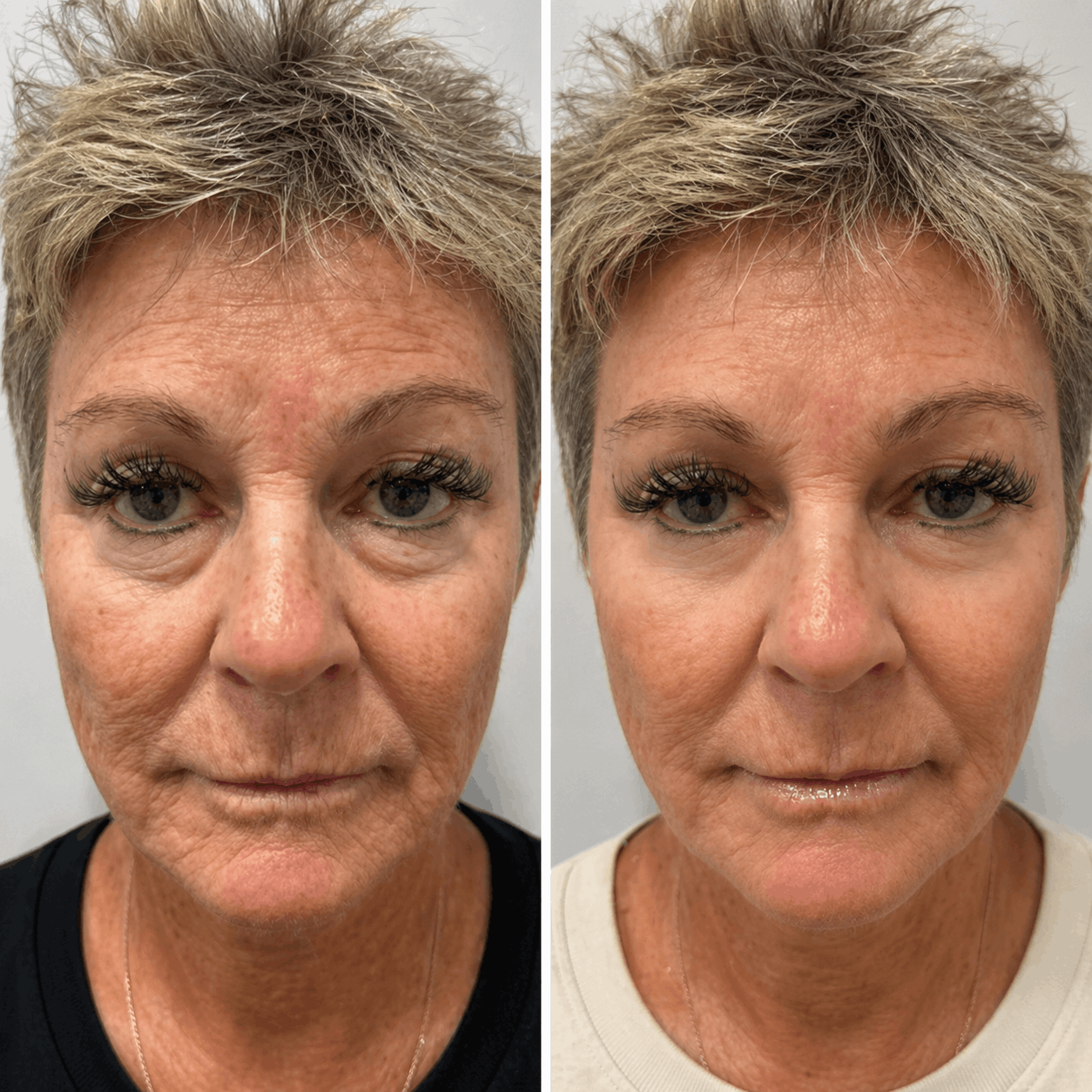 Before and after Velino LUMEX Eye Lift – visible reduction in under-eye bags, dark circles and fine lines around the eyes after consistent use