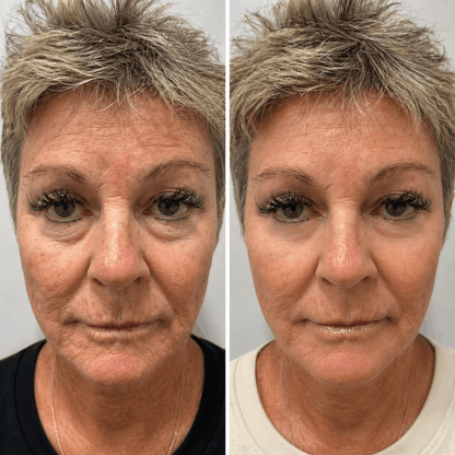 Before and after Velino LUMEX Eye Lift – visible reduction in under-eye bags, dark circles and fine lines around the eyes after consistent use