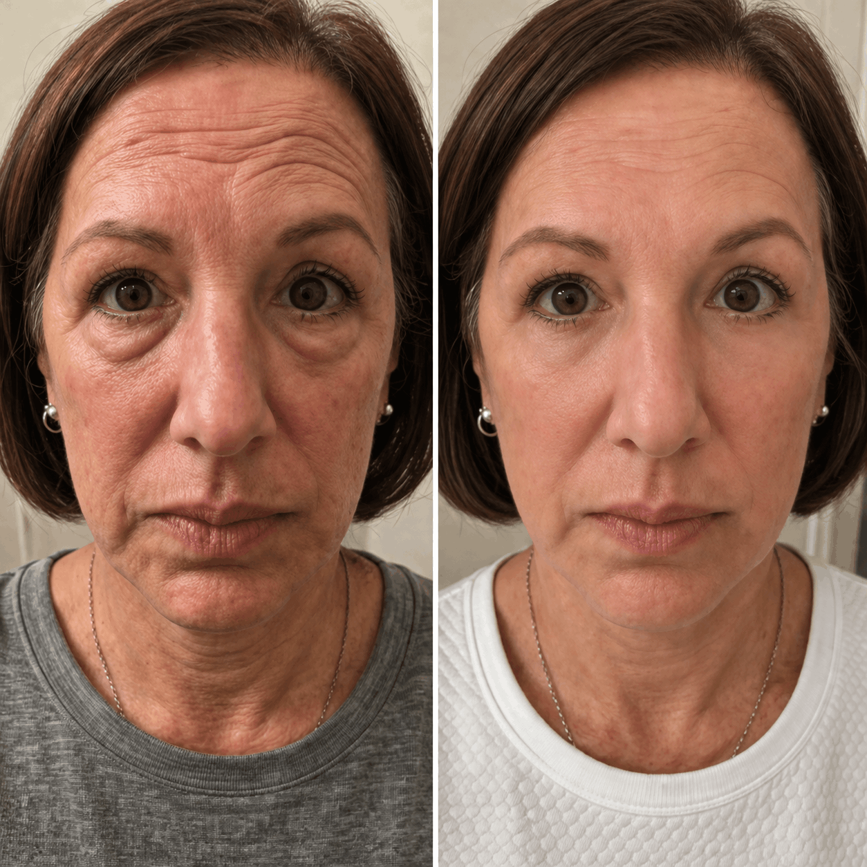 Before and after Velino LUMEX Eye Lift – visible reduction in under-eye bags, dark circles and fine lines around the eyes after consistent use